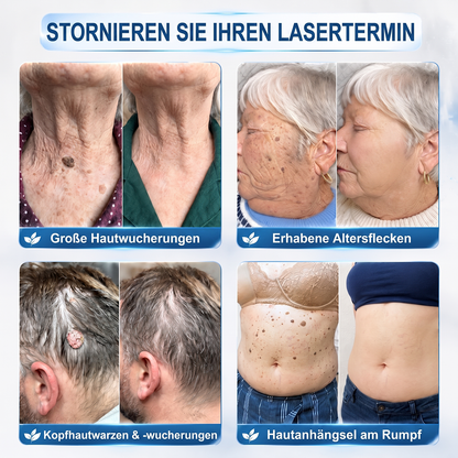 ⭐𝐇𝐈𝐒𝐊𝐈𝐍®👩‍⚕️⭐ 7-Tage-Hautmakel- & Hautanhängsel-Entferner Schmerzfreier Rollerball-Stift zur schonenden Entfernung von Hautanhängseln und Hautflecken – narbenfrei