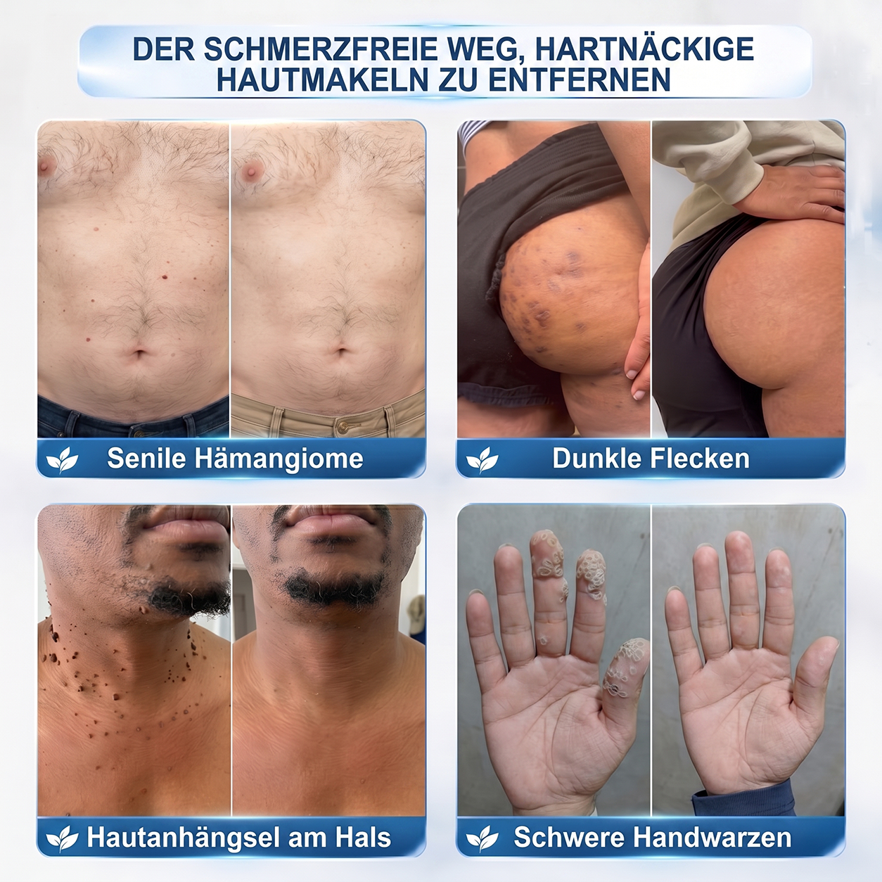 ⭐𝐇𝐈𝐒𝐊𝐈𝐍®👩‍⚕️⭐ 7-Tage-Hautmakel- & Hautanhängsel-Entferner Schmerzfreier Rollerball-Stift zur schonenden Entfernung von Hautanhängseln und Hautflecken – narbenfrei