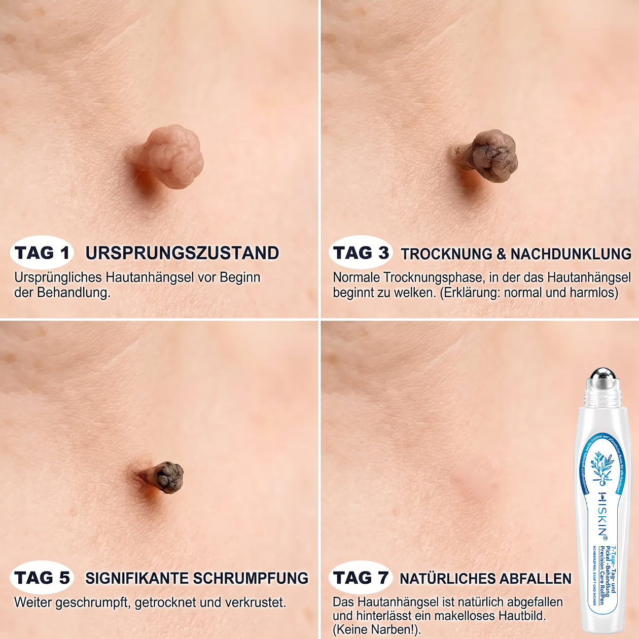 ⭐𝐇𝐈𝐒𝐊𝐈𝐍®👩‍⚕️⭐ 7-Tage-Hautmakel- & Hautanhängsel-Entferner Schmerzfreier Rollerball-Stift zur schonenden Entfernung von Hautanhängseln und Hautflecken – narbenfrei