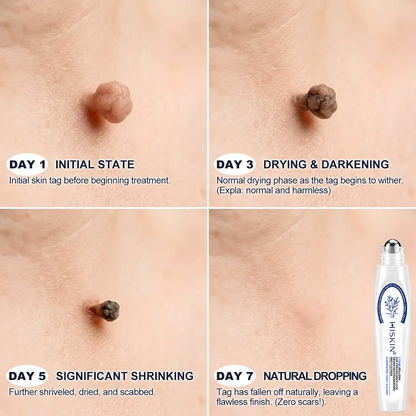 HISKIN®👩‍⚕️ 7-Tage-Hautmakel- & Hautanhängsel-Entferner Schmerzfreier Rollerball-Stift zur schonenden Entfernung von Hautanhängseln und Hautflecken – narbenfrei